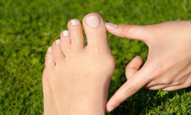 A Podiatrist Answers Your Bunion FAQs